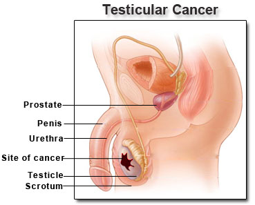 Tanning gene linked to increased risk of testicular cAncer